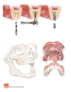krans Renderen Ook Tandheelkundige implantaten | MKA Kennemer & Meer